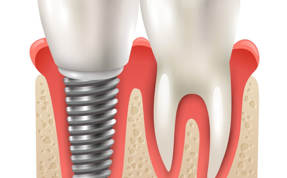 Dental implants and tooth set model closeup side view realistic image vector illustration