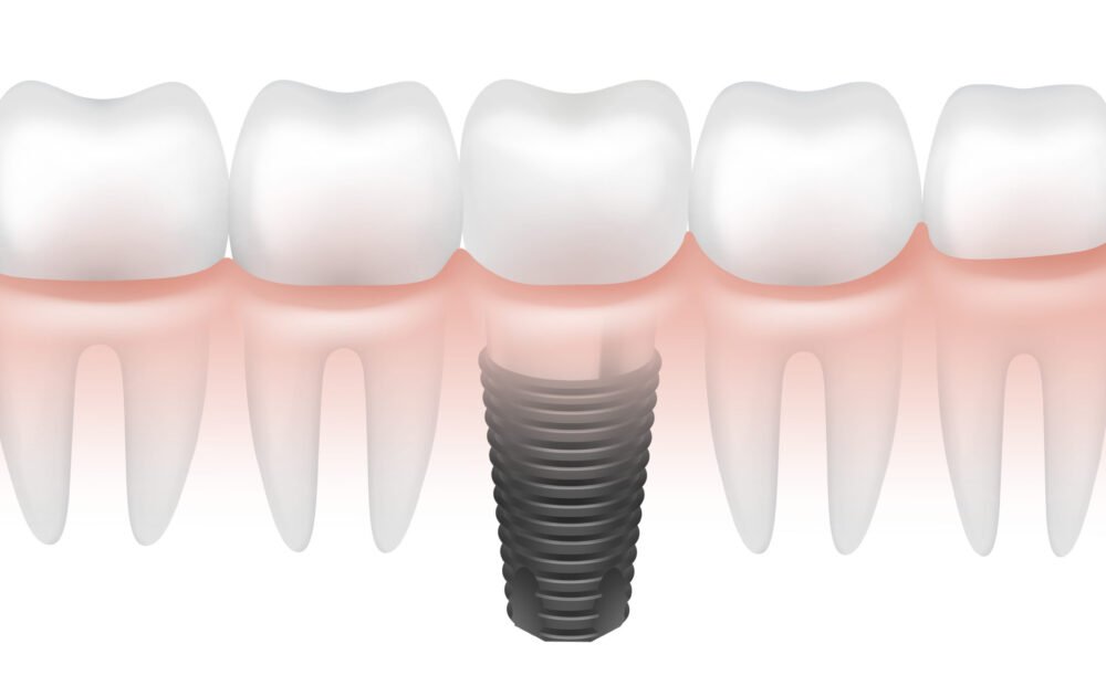 Vector metal dental implant between other teeth in gum side view isolated on white background